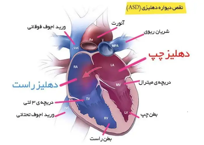 بستن سوراخ بین دهلیزی
