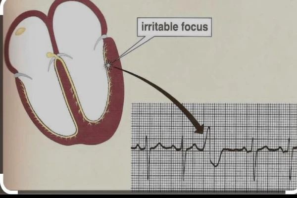 علائم پی وی سی قلب