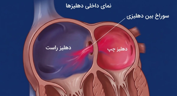 نمایش سوراخ بین دهلیزی