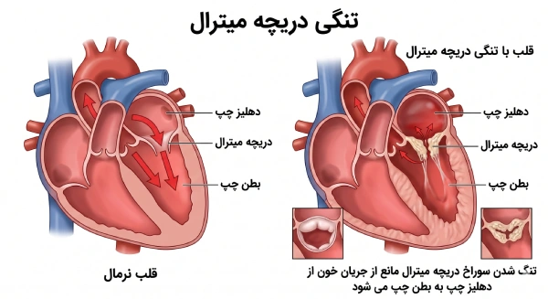 تنگی دریچه میترال