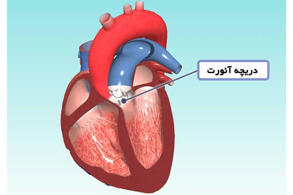 دریچه ائورت